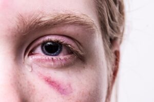 整形外科の当直で高額な外傷治療費はどのくらい？